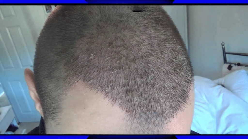 10 days after hair transplant