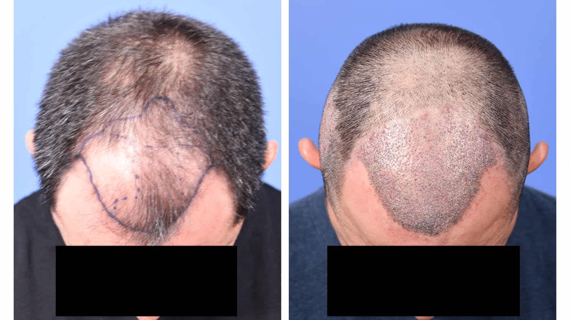 10 days after hair transplant (2)