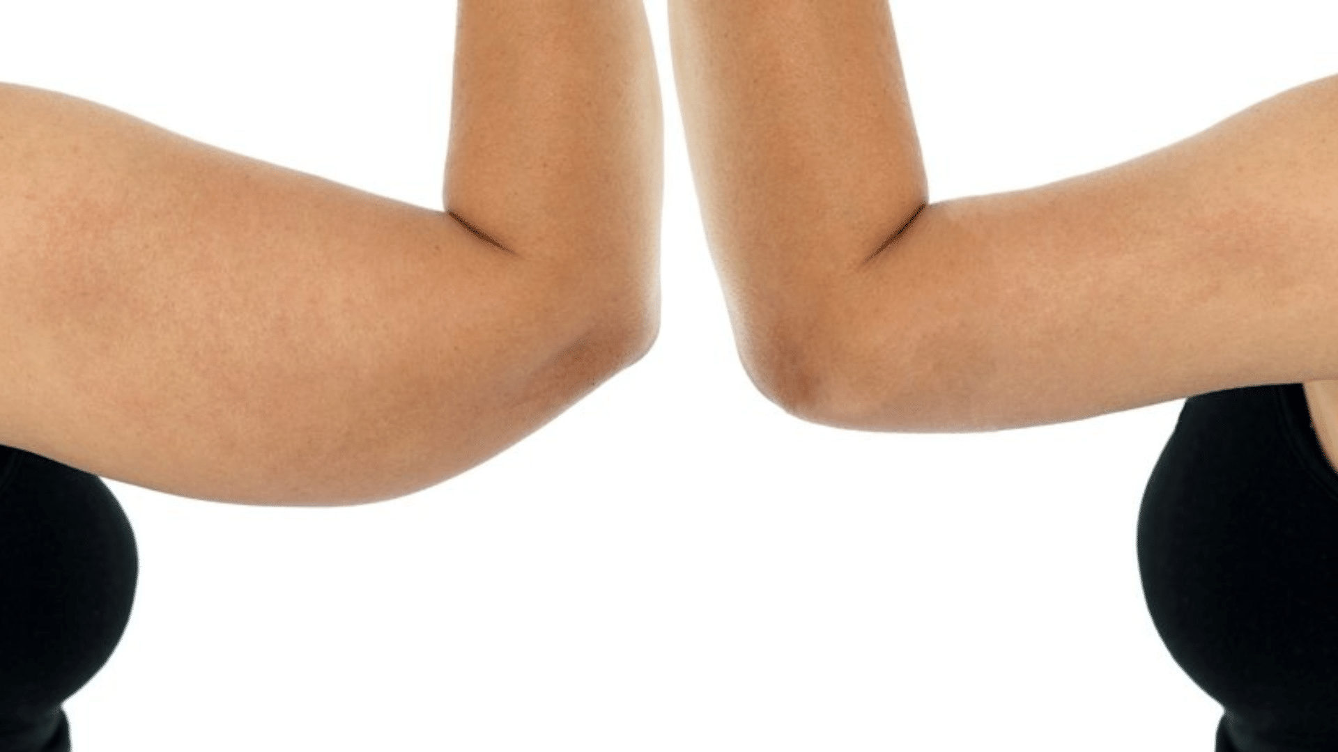 Arm Lift (Brachioplasty)