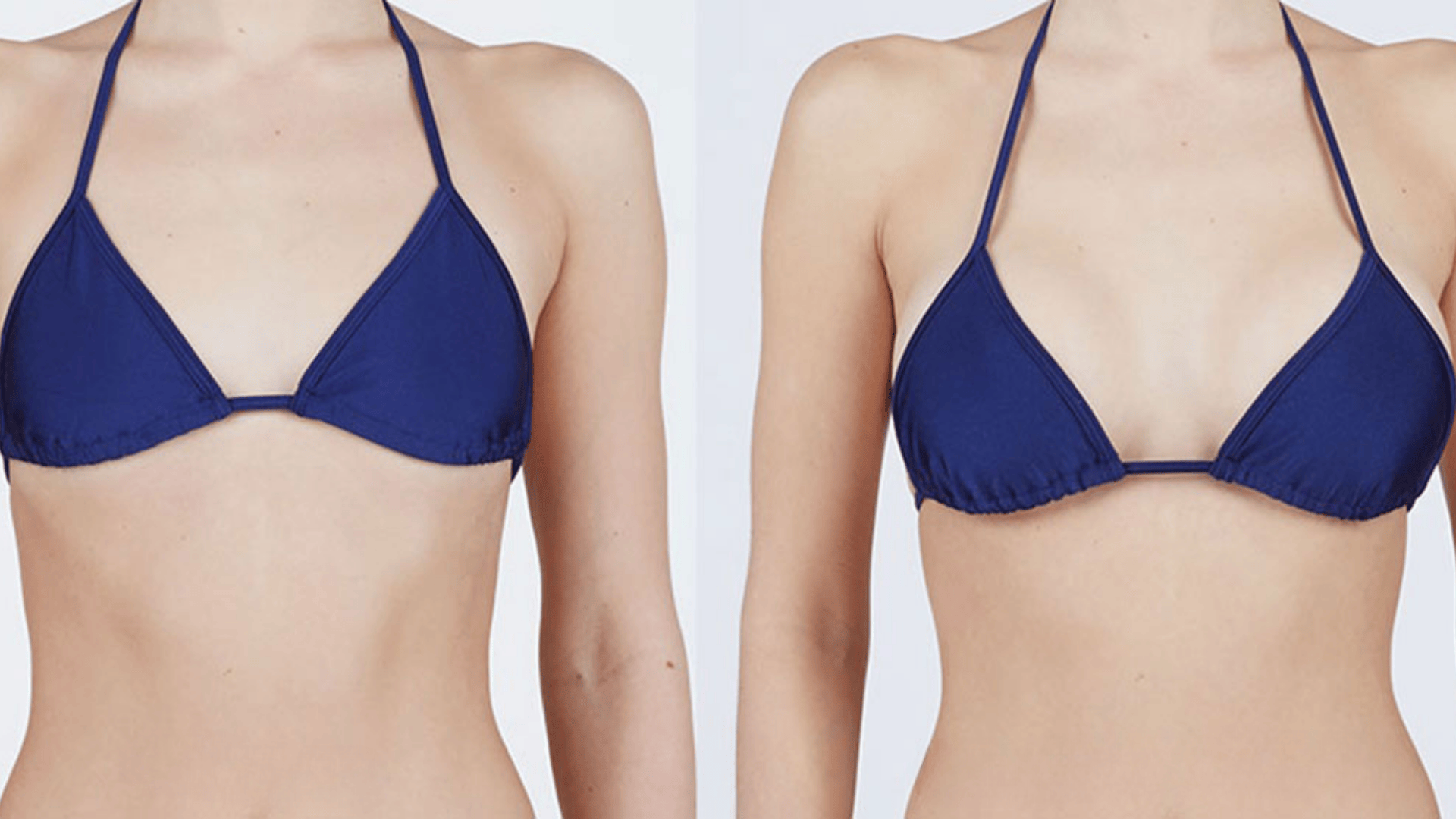 Breast-Augmentation-and-Lift