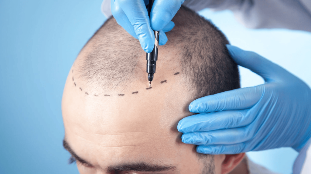 Hair Transplant Before and After