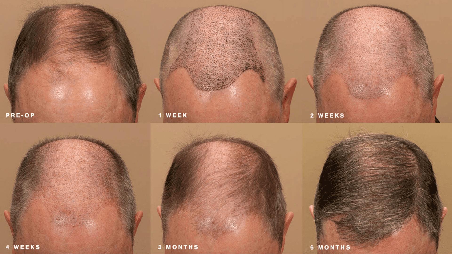 Hair Transplant Recovery Timeline and Visible Changes