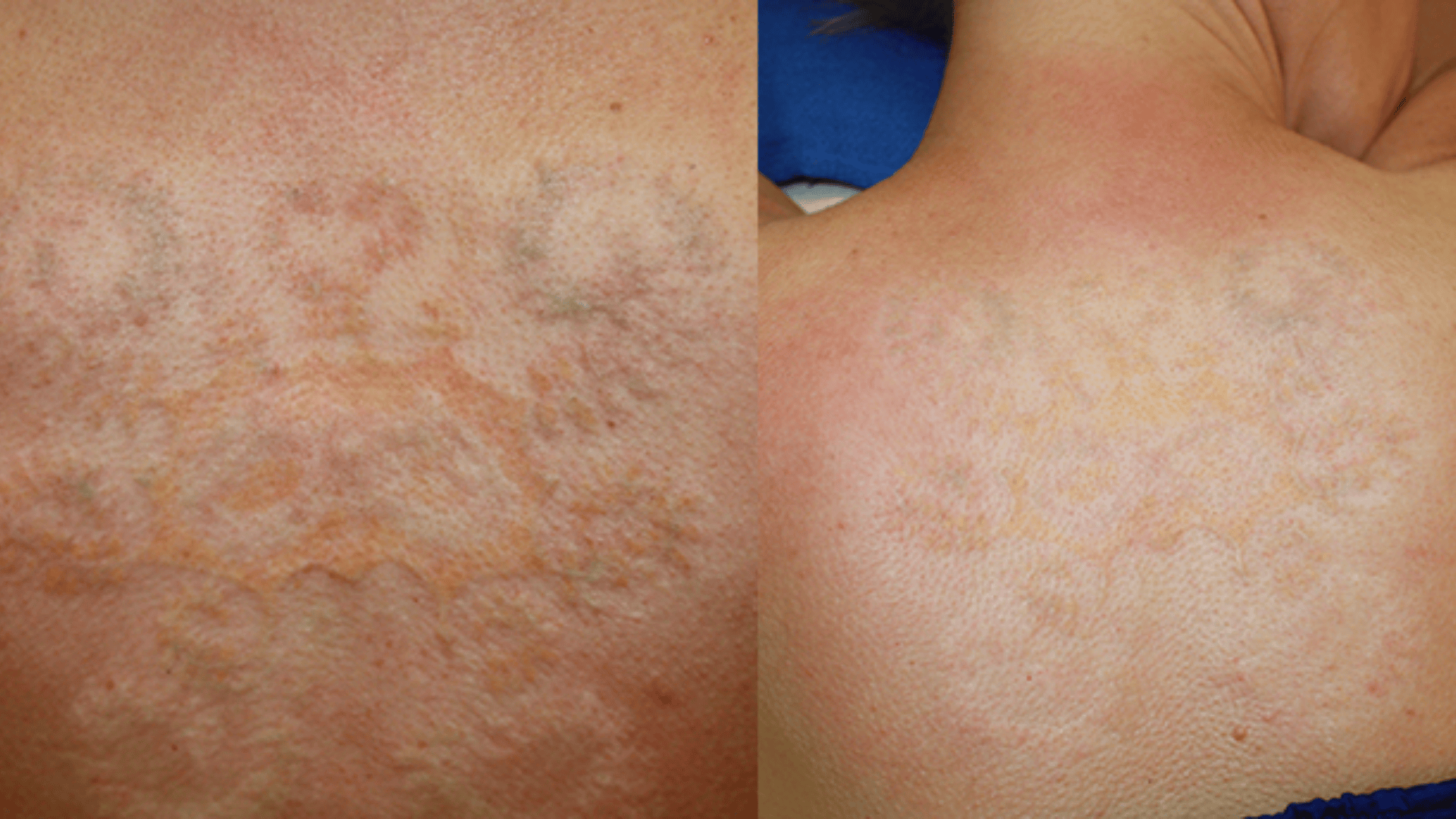 Healing-Timeline-for-Skin-After-Tattoo-Removal