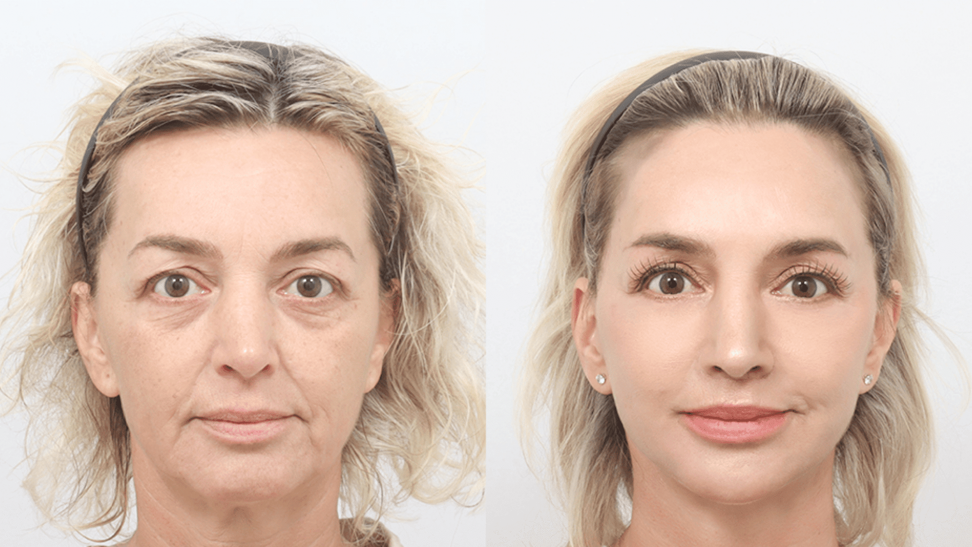 How-to-Evaluate-Before-and-After-Plastic-Surgery-Results