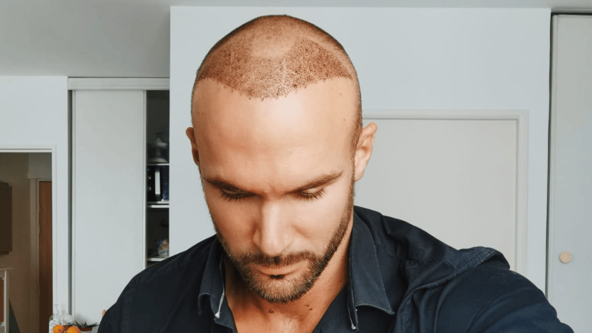 How to Evaluate Hair Transplant Results Effectively