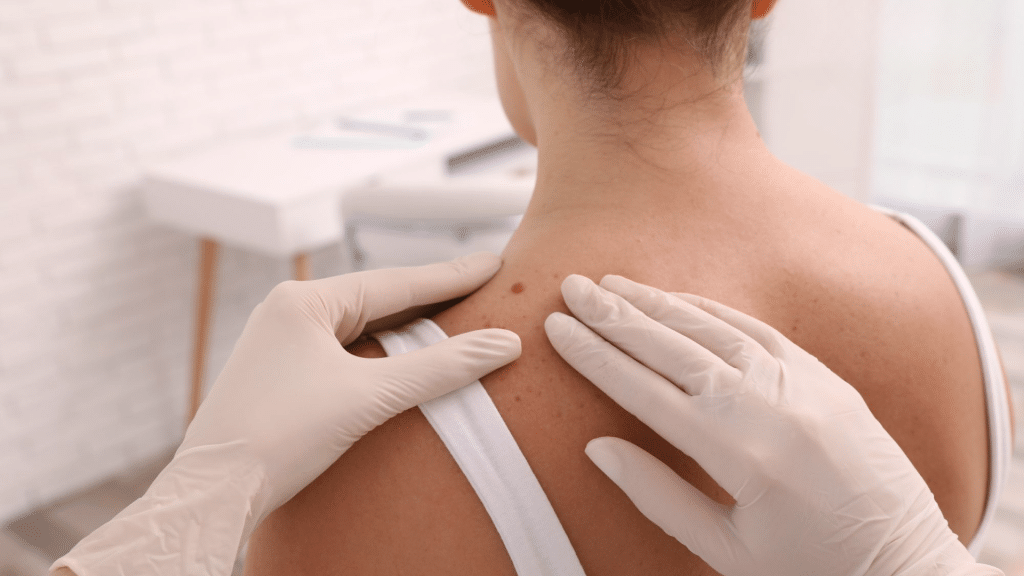 My Step-By-Step Guide to Laser Skin Tag Removal