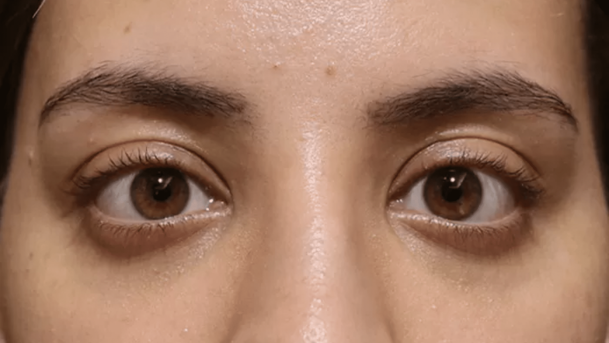 Protruding (Prominent) Eyes