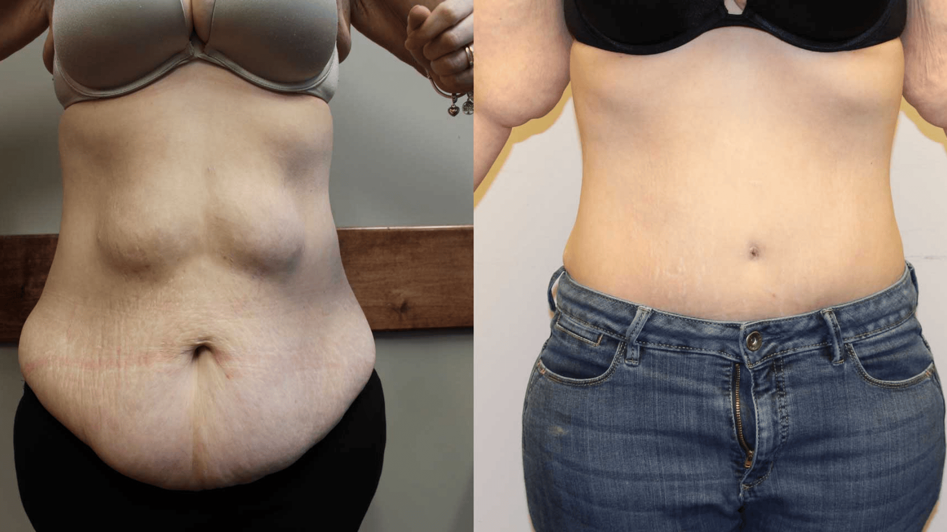 Tummy-Tuck-(Abdominoplasty)