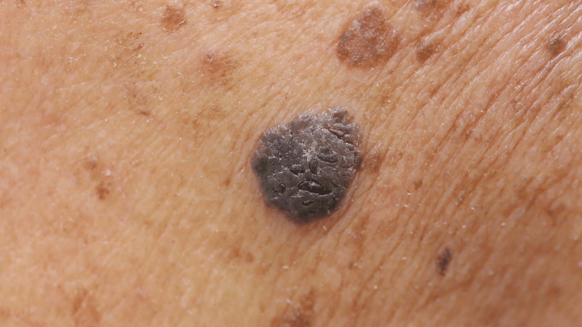 What Causes Moles and When They Need Attention