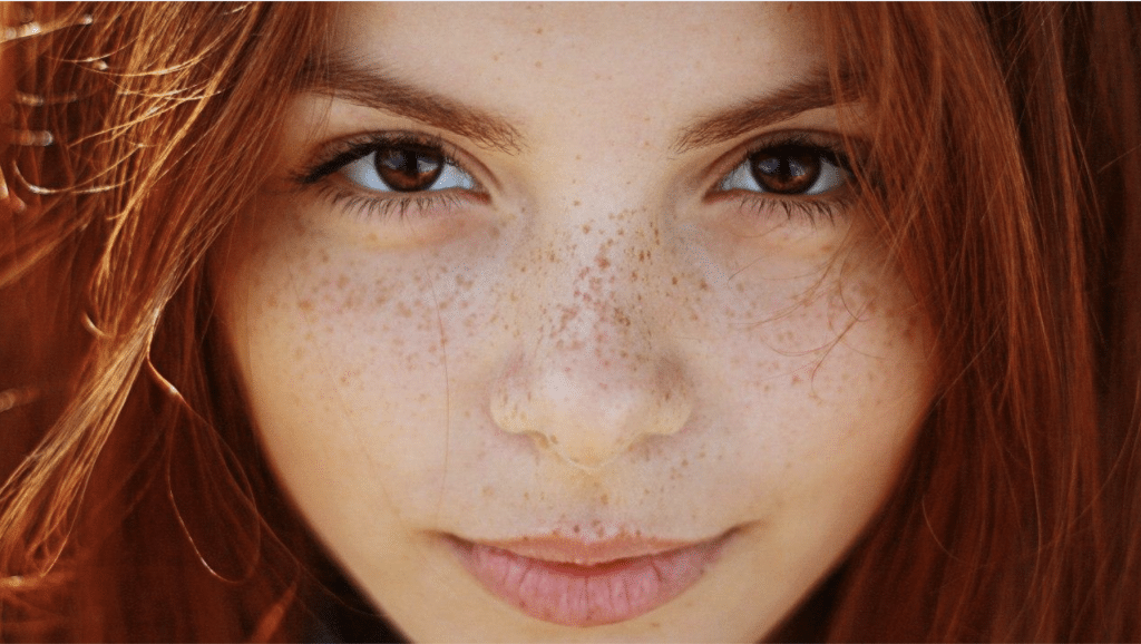 freckle treatments