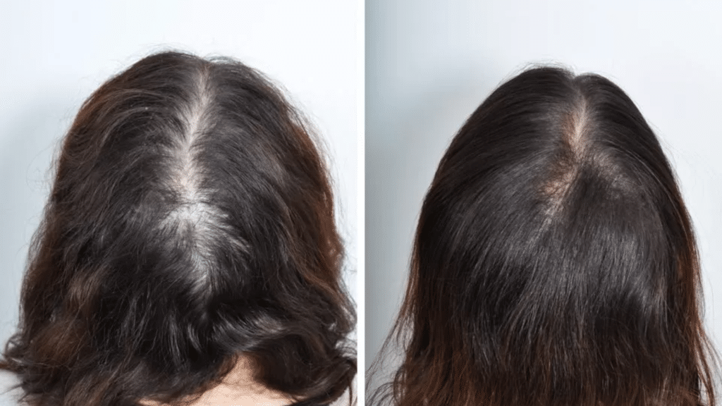 hair implants for women
