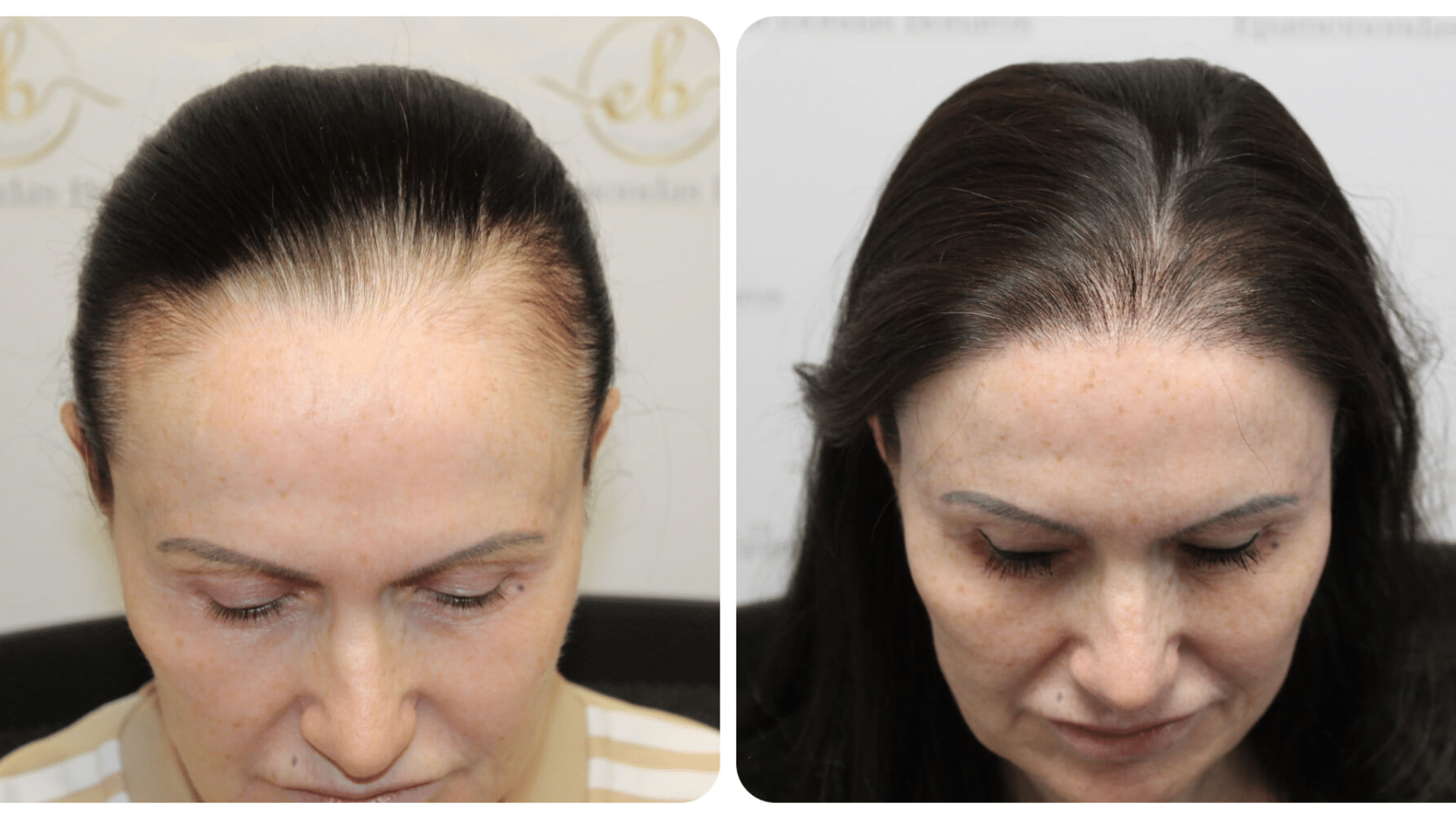 hairline restoration