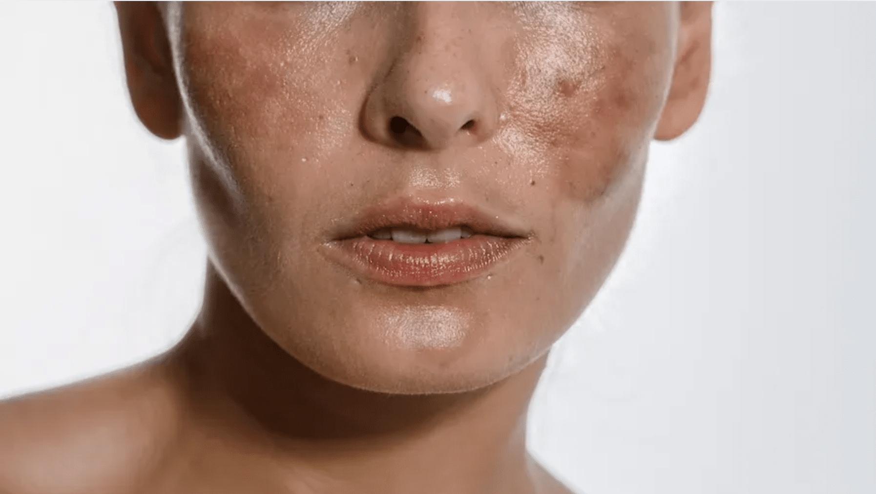 hyperpigmentation laser treatment-1