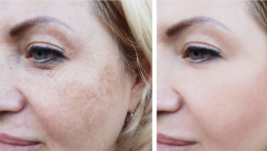hyperpigmentation laser treatment