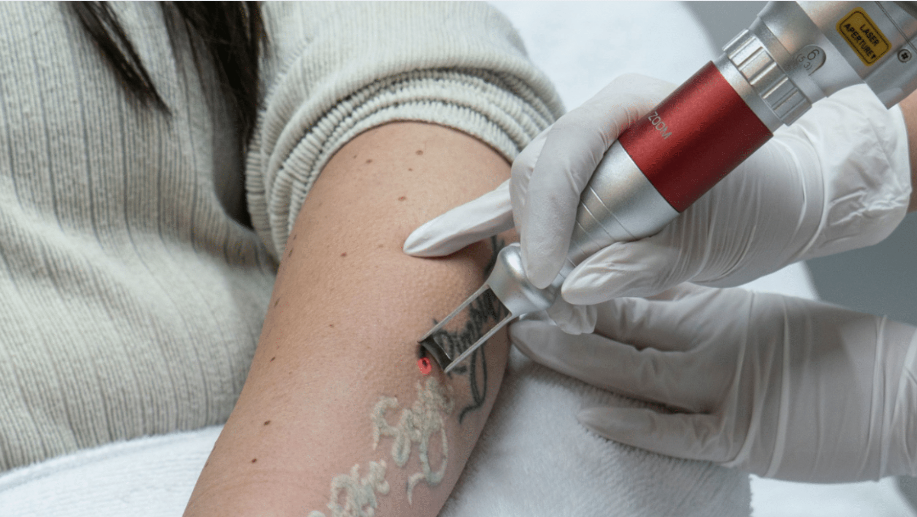 picoway tattoo removal