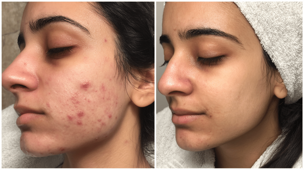 spironolactone before and after