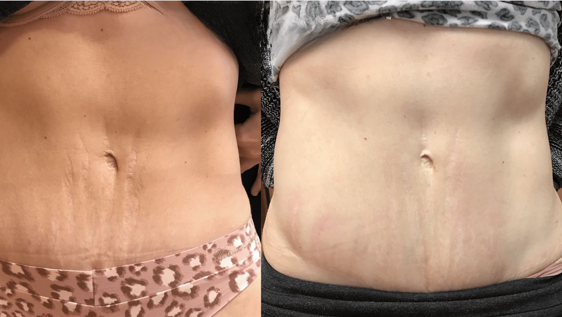 stretch mark removal laser