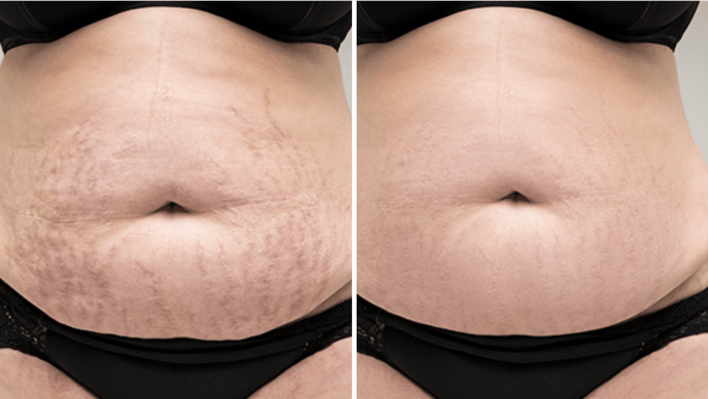 stretch mark removal laser